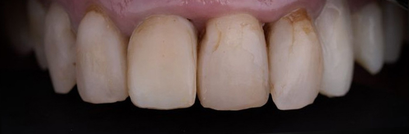 01-before